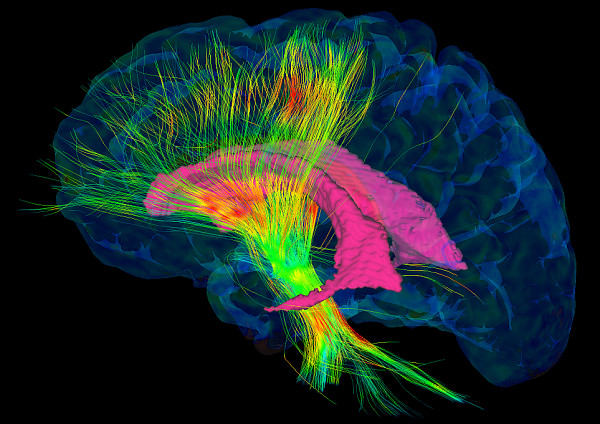 L&rsquo;alliance entre l&rsquo;informatique et l&rsquo;imagerie m&eacute;dicale permet une meilleure pr&eacute;cision lors des chirurgies au cerveau.