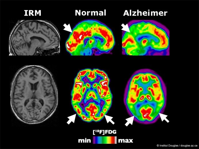 Images de la structure (IRM) et de l’activité (TEP) du cerveau. La maladie d’Alzheimer est associée à une diminution de la consommation de sucre (FDG) dans des régions précises indiquées par les flèches.