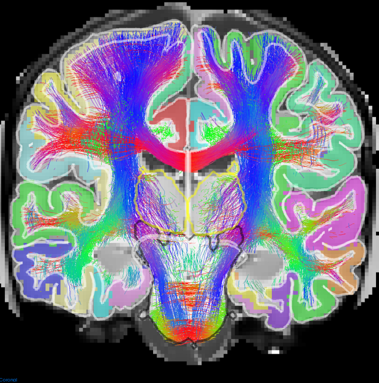 La Chaire de recherche en neuroinformatique travaille depuis 2017 à cartographier les voies de communication dans le cerveau. (Image réalisée par E. St-Onge, membre du groupe de recherche du Pr Descoteaux)