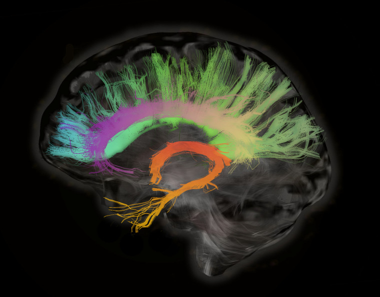 The imaging technology developed by Prof.  Descoteaux helps medicine treat difficult-to-treat neurological diseases.  (Image produced by C. Presseau, member of the research team)