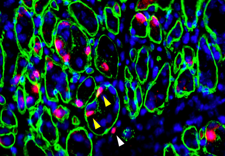 Lors de l’analyse des muscles dystrophiques ayant subi la transplantation de cellules souches, nous pouvons détecter des fibres musculaires génétiquement corrigées en utilisant une coloration pour le produit du gène sain qui a été réintroduit (vert) et nous pouvons visualiser les noyaux dérivés de cellules humaines (rouge). Cela montre les noyaux dérivés du donneur à l'intérieur des fibres (pointes de flèche jaunes) ainsi que des cellules à l'extérieur (pointes de flèche blanches) qui n'ont pas fusionné et restent des cellules souches qui peuvent être réactivées.