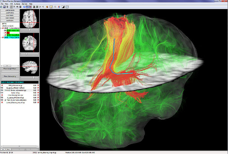 Un aspect du logiciel NeuroPlanning Navigator : on y voit une tumeur, des fibres neuronales en transparence et des outils de mesure.