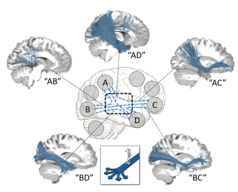 Diagramme démontrant des bouchons de circulation dans le cerveau, vu de plusieurs angles.