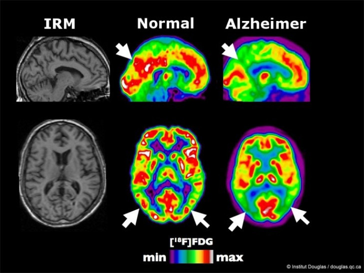 Le Carburant Du Cerveau Un Facteur Dans La Maladie D Alzheimer Actualites Universite De Sherbrooke